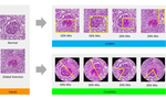 Improve Global Glomerulosclerosis Classification with Imbalanced Data using CircleMix Augmentation