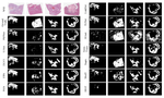 Evaluating Transformer-based Semantic Segmentation Networks for Pathological Image Segmentation
